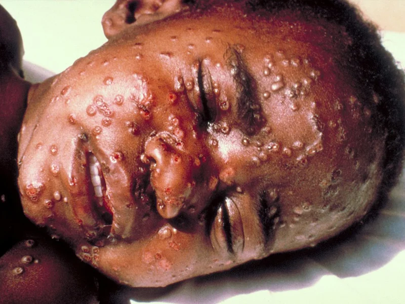 smallpox-800x600 Smallpox
